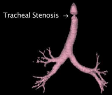 tracheal-stneosis