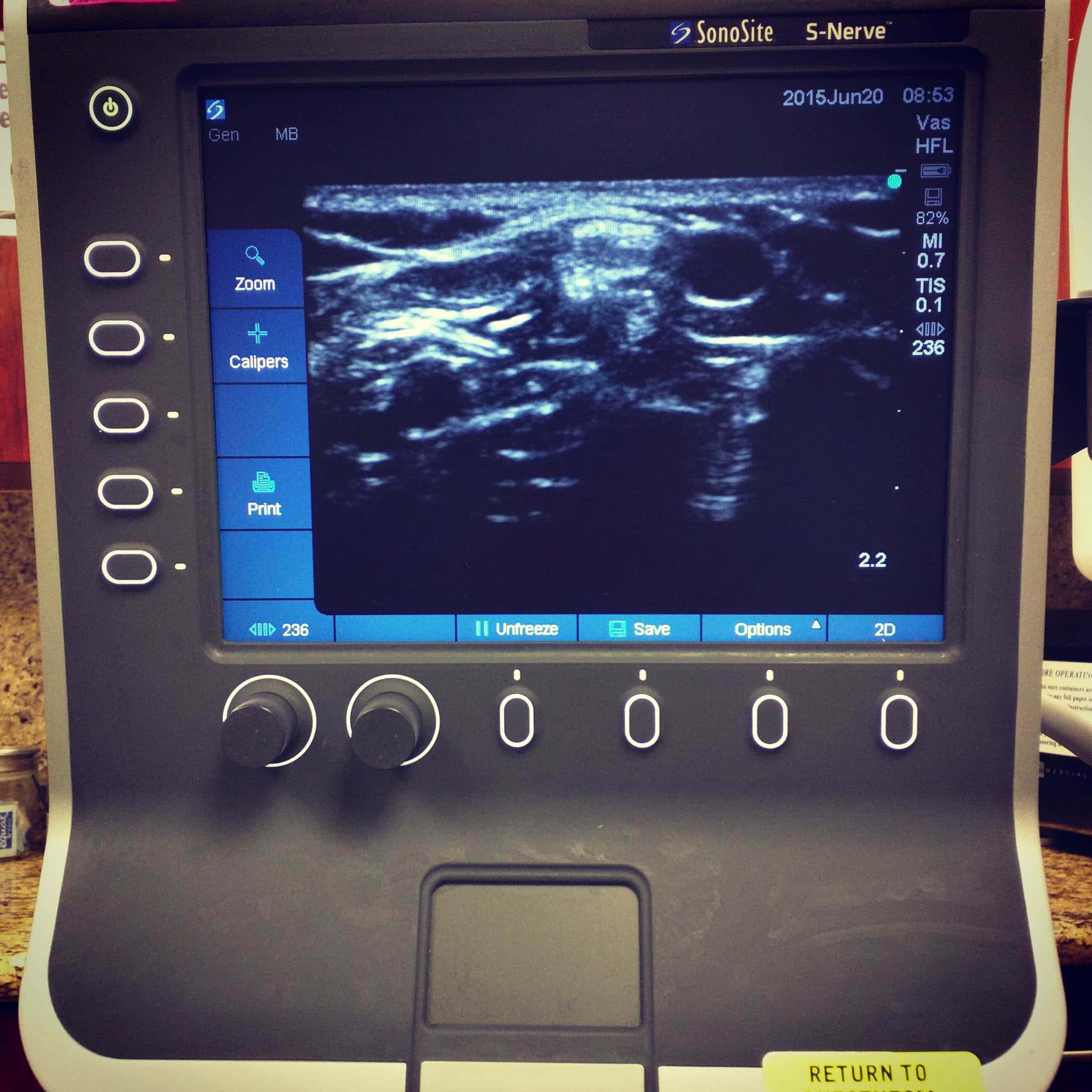 Rishi Brachial Artery Sonosite Ultrasound