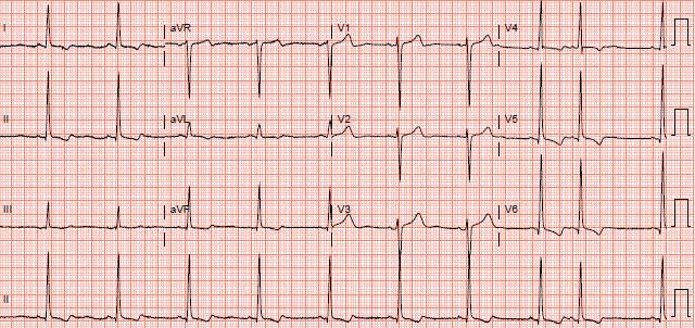 ECG Lead II And Volume Responsiveness – The Brody Effect