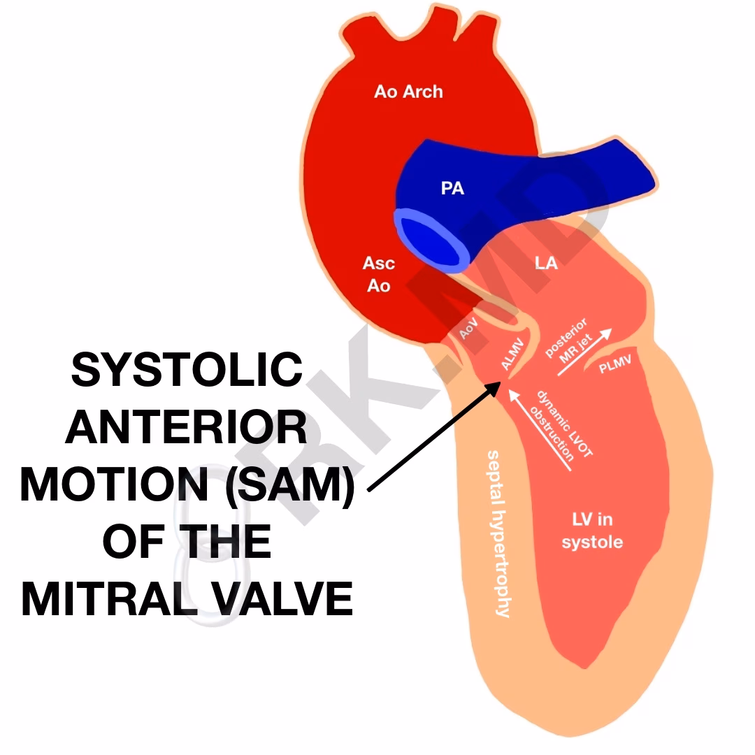 Systolic Anterior Motion (SAM) Of The Mitral Valve – Left Ventricular Outflow Tract (LVOT) Obstruction