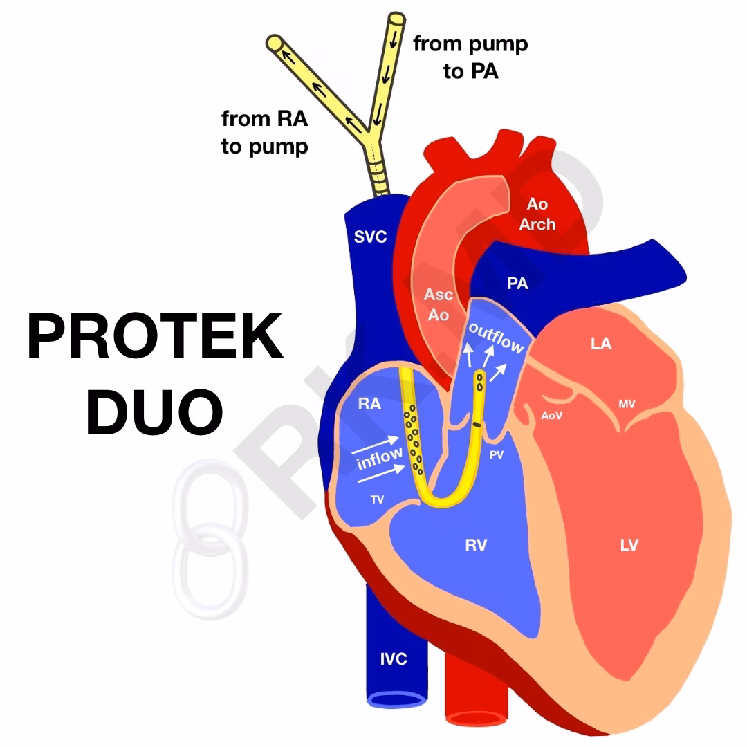 ProtekDuo® Veno-Venous Cannula