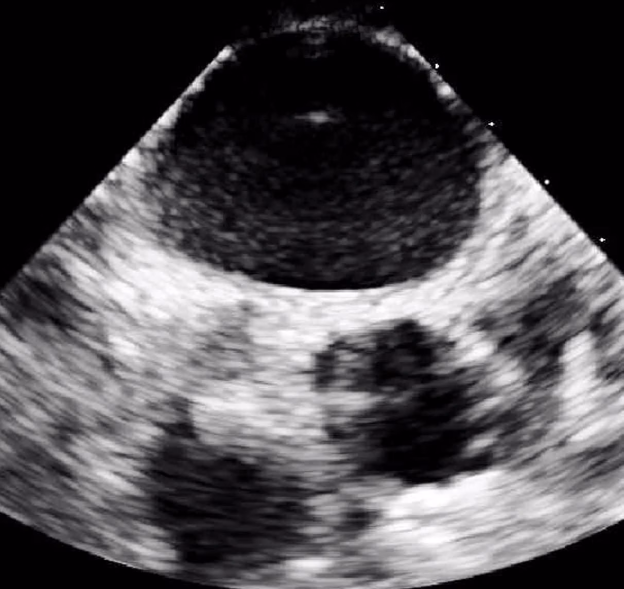 Epiaortic Ultrasound (EAS)