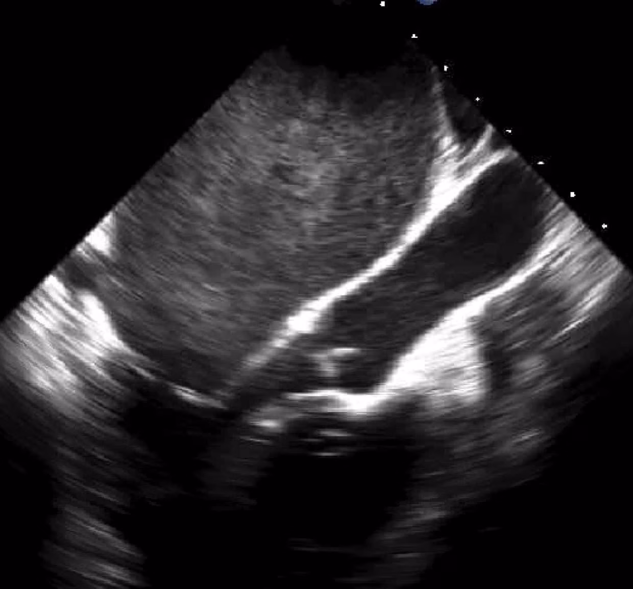 Left Atrial Spontaneous Echo Contrast (SEC)