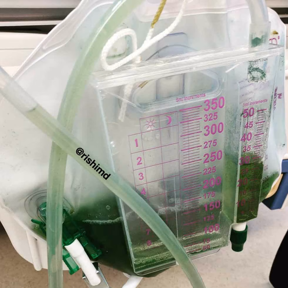 Green Urine Discoloration