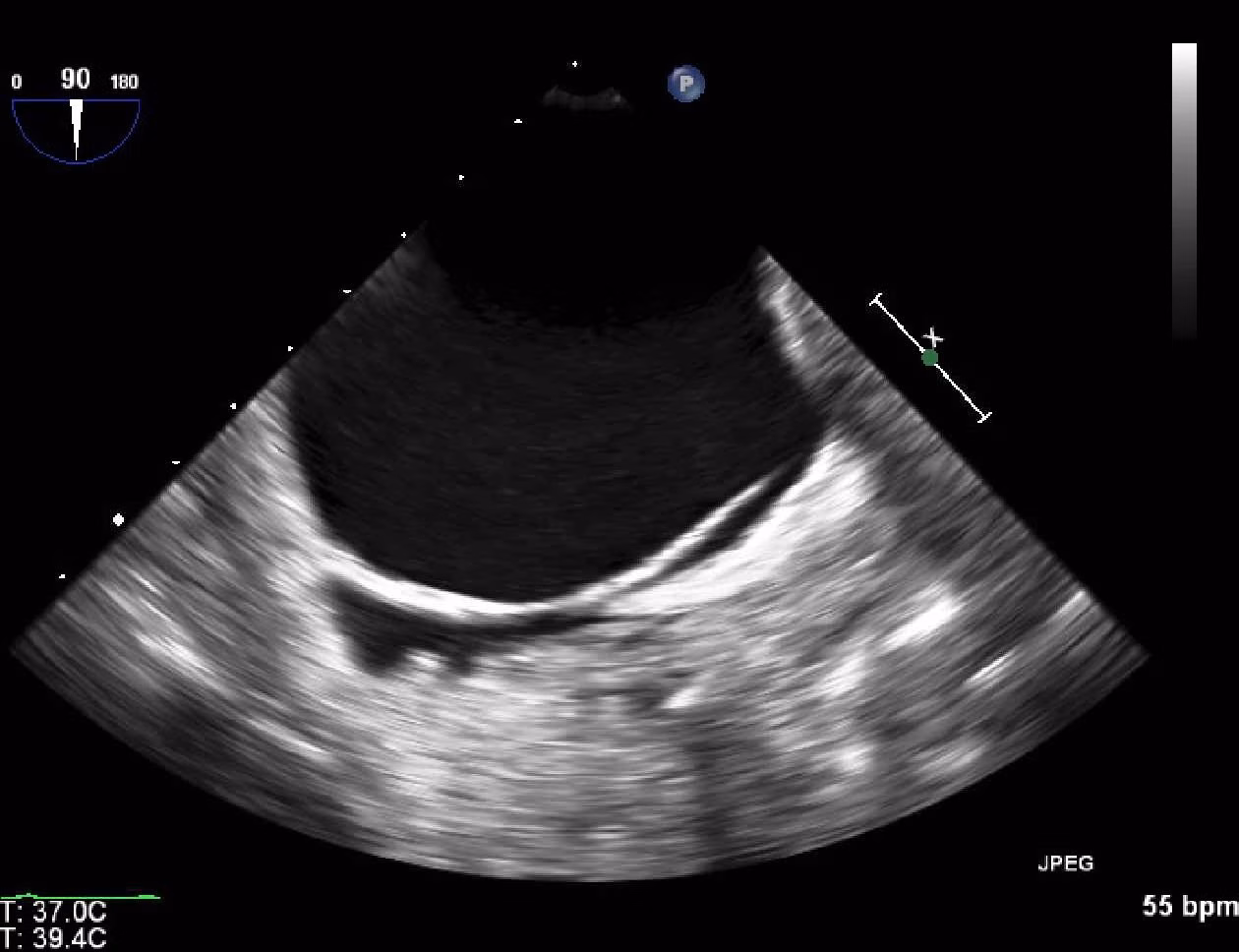Bubble Study On Transesophageal Echocardiography