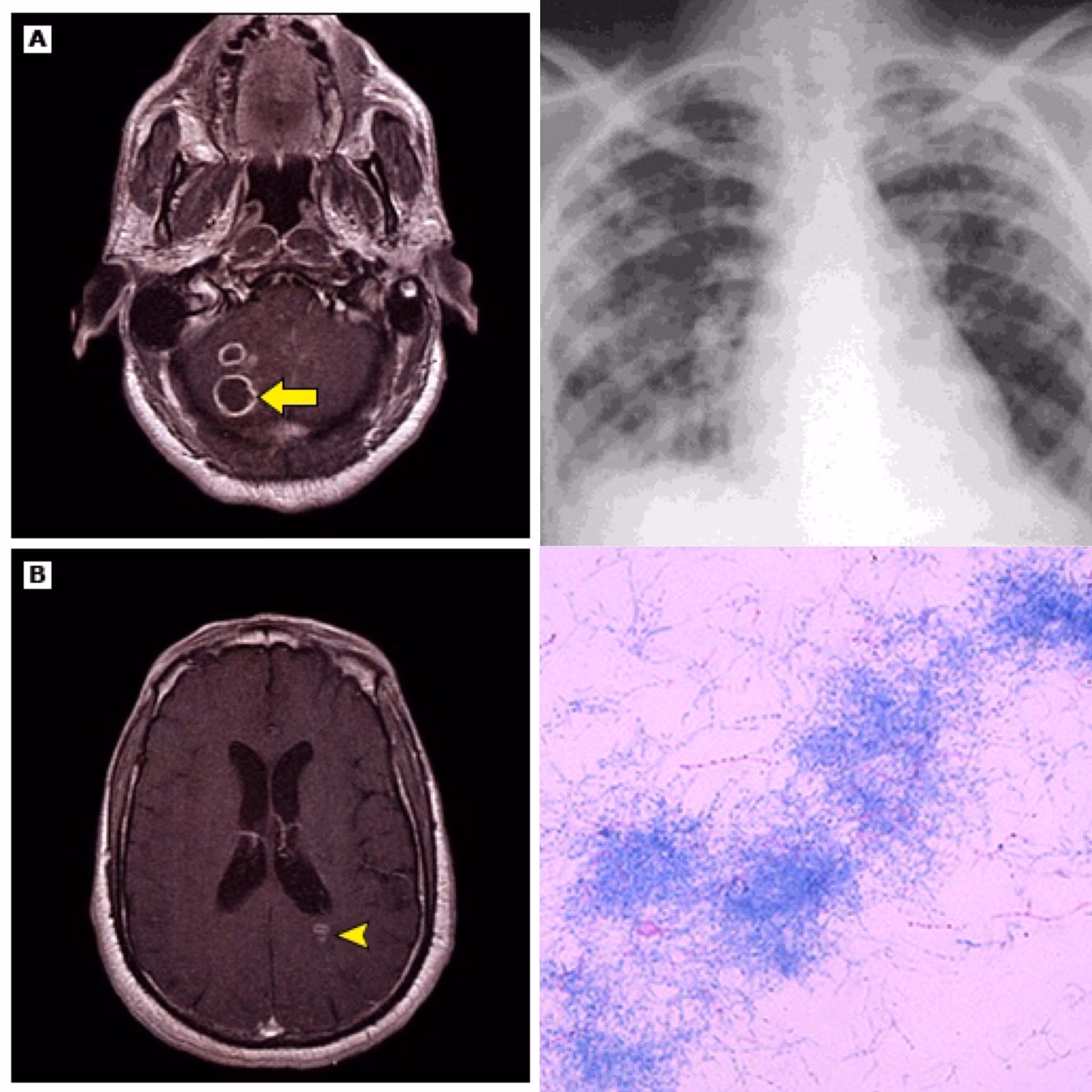 Nocardiosis