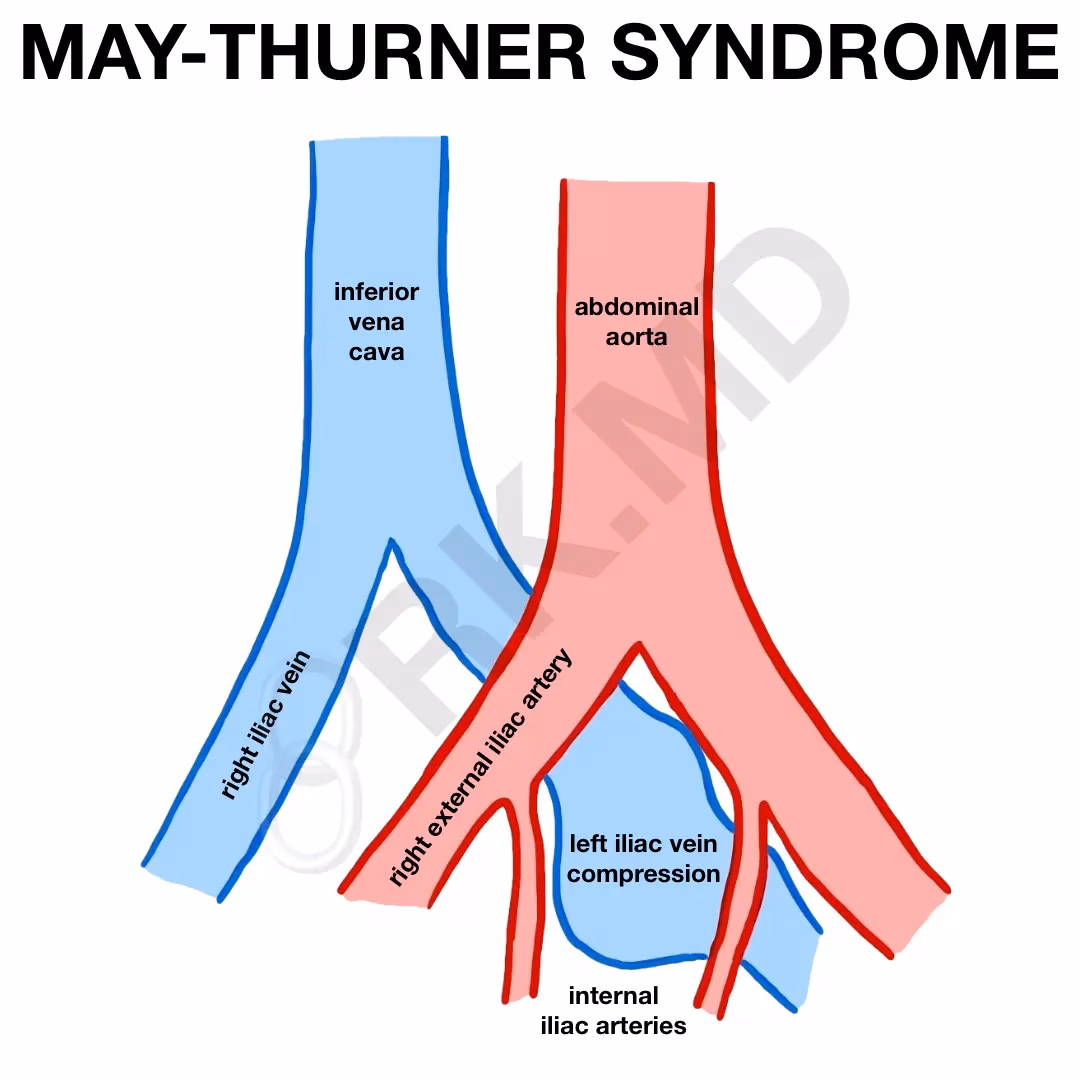 May-Thurner Syndrome