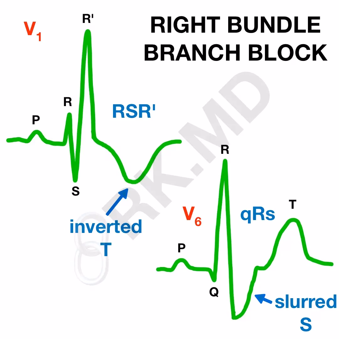Right Bundle Branch Block ECG Findings