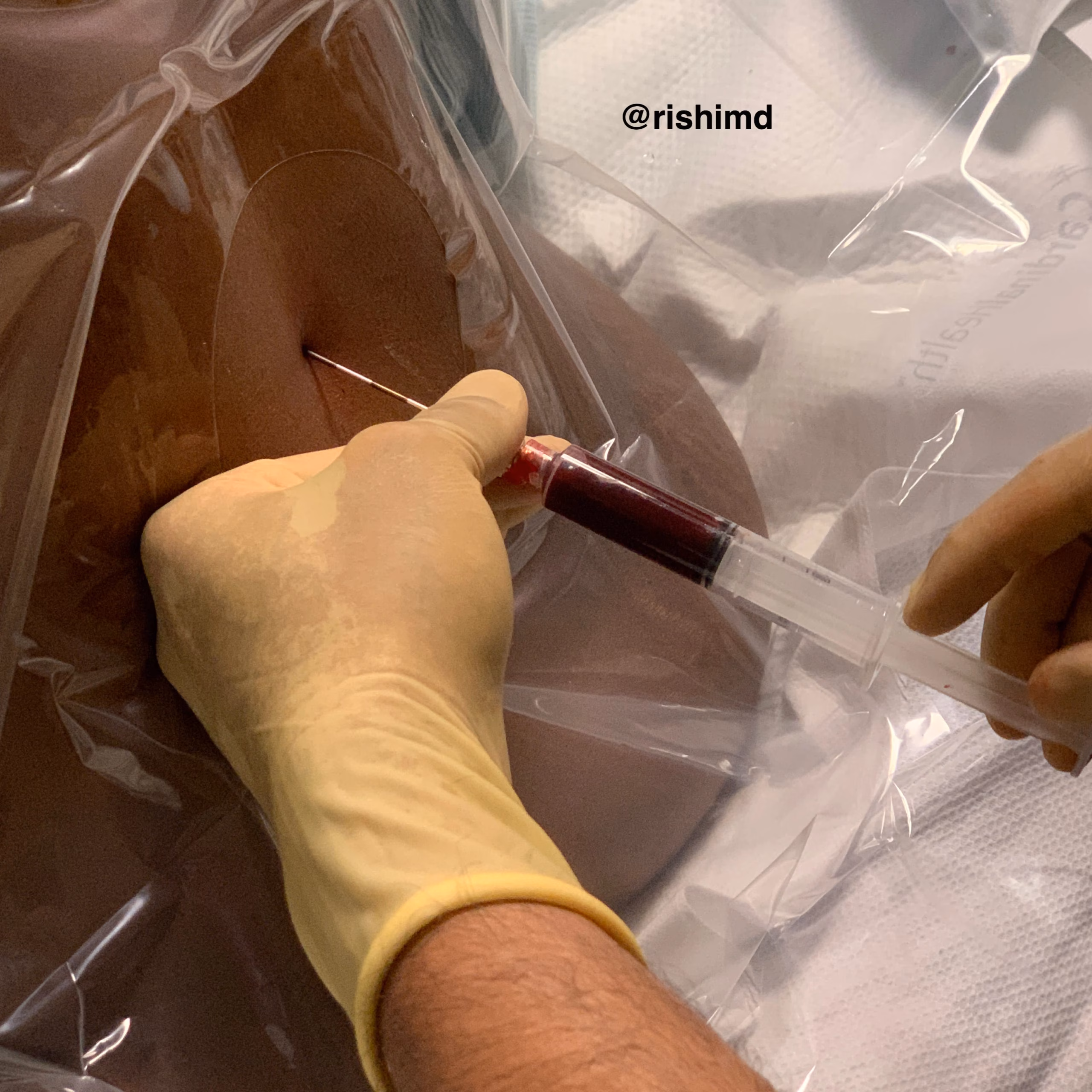 Epidural Blood Patch (EBP)