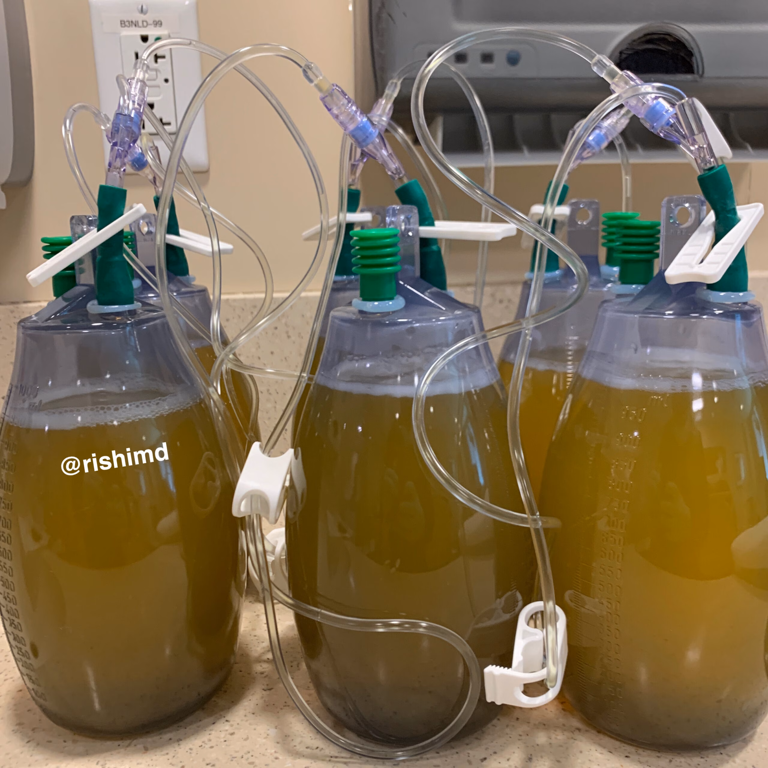 Large Volume Paracentesis