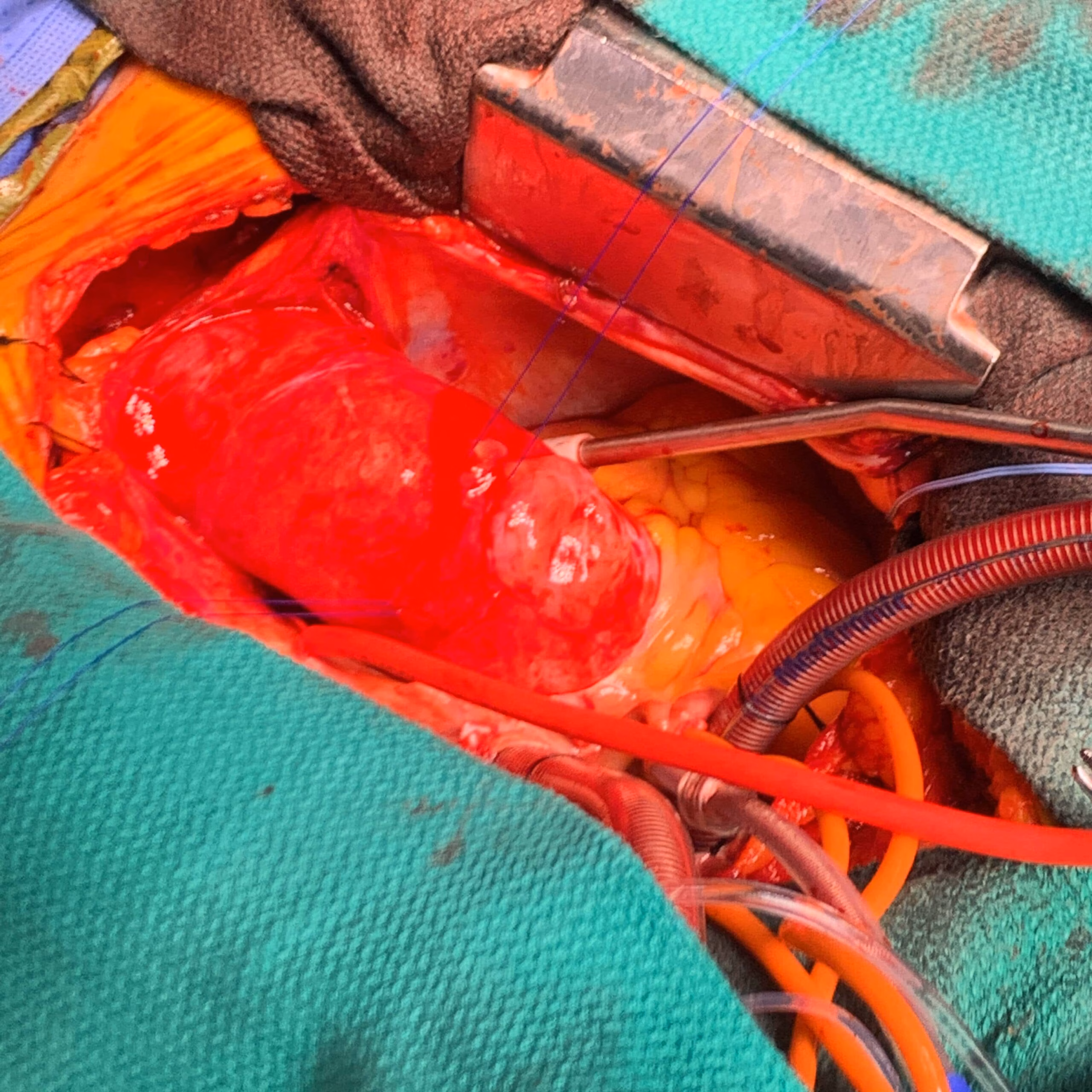 Type A Dissection