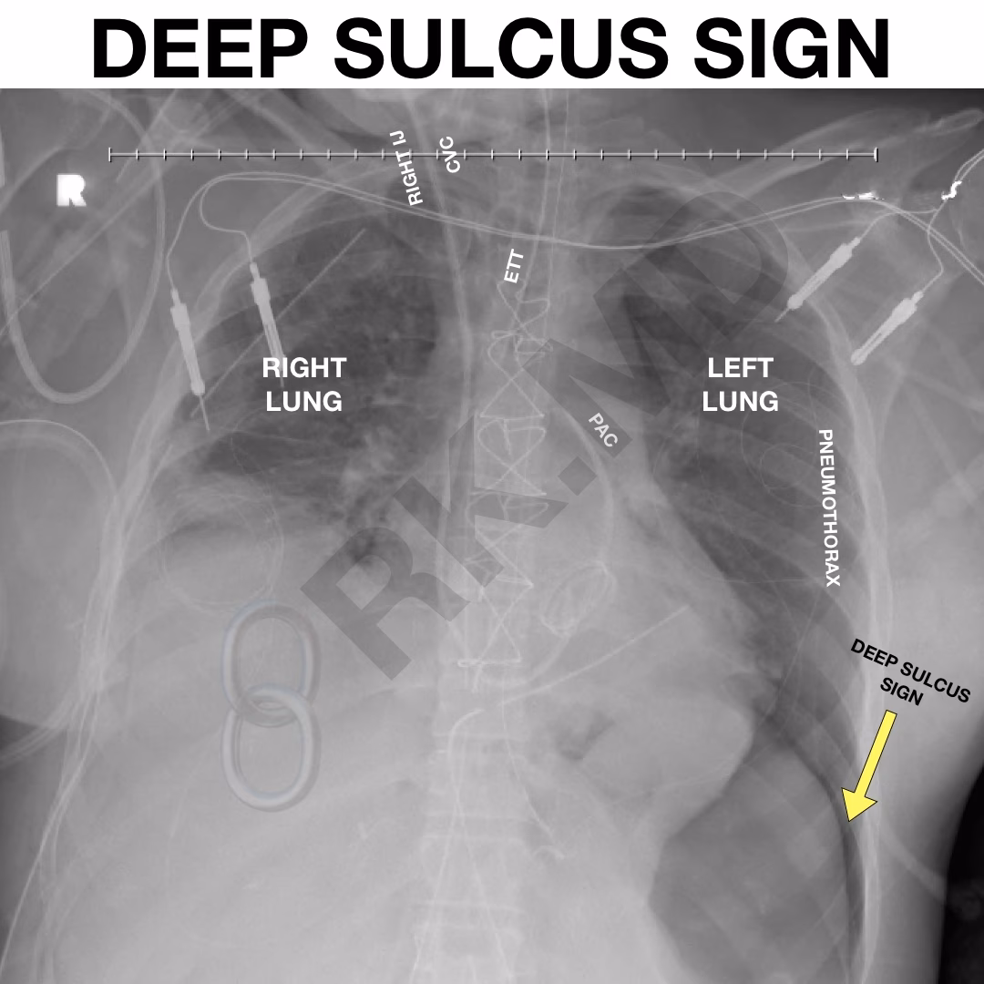 Deep Sulcus Sign