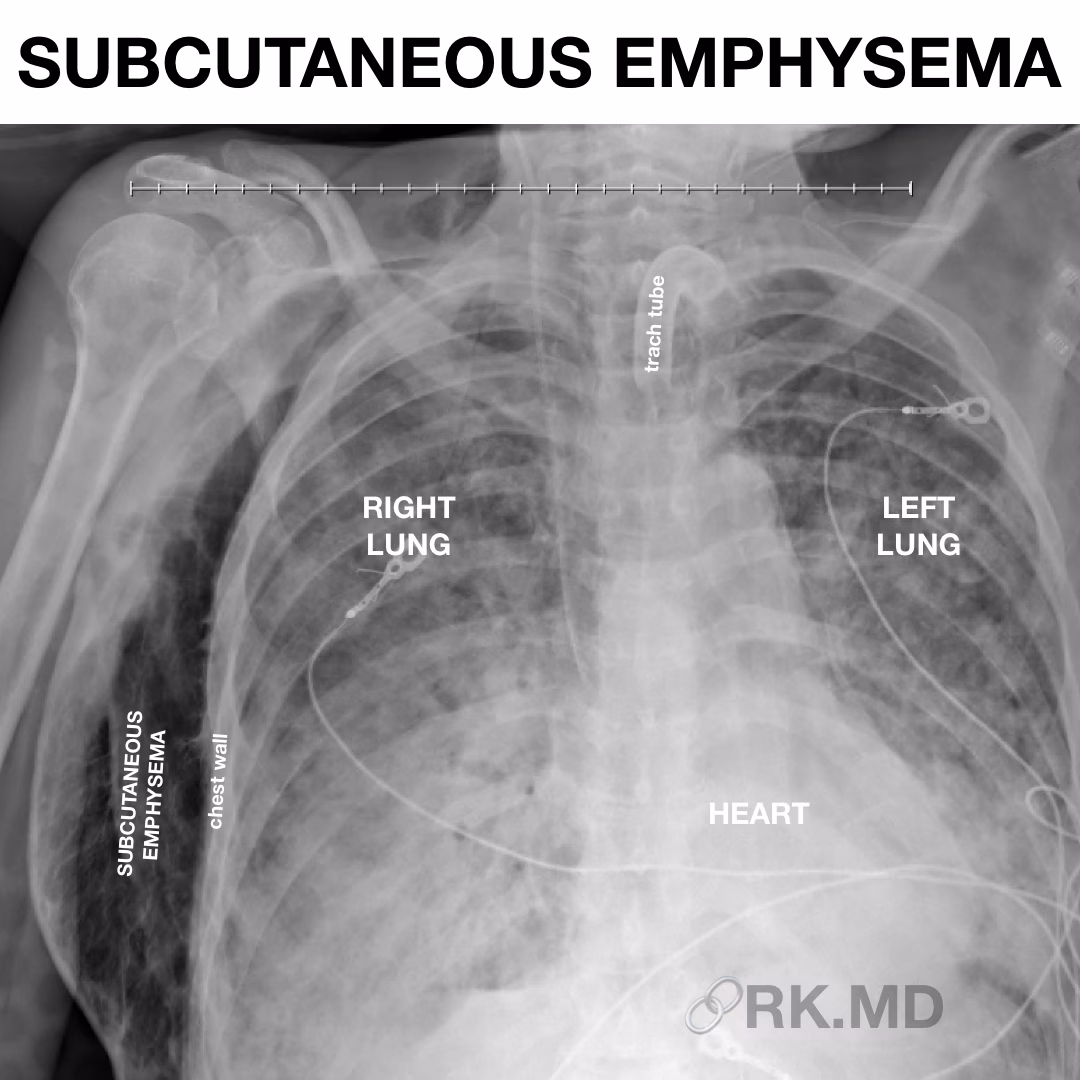 Subcutaneous Emphysema