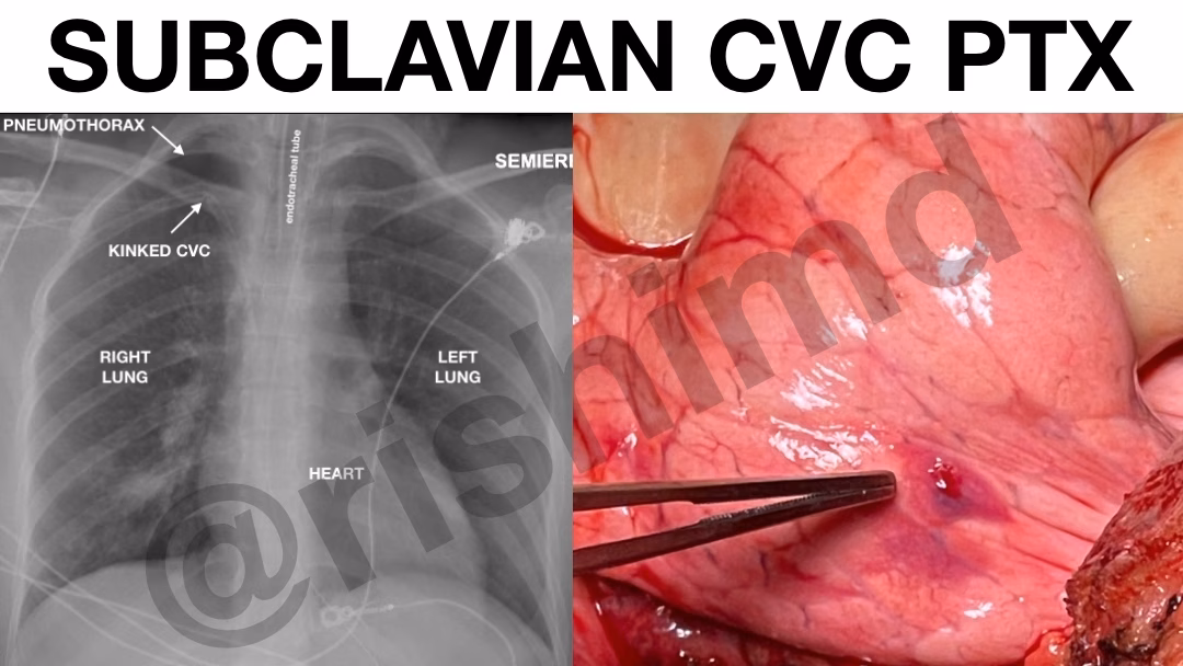 Subclavian Central Line Pneumothorax