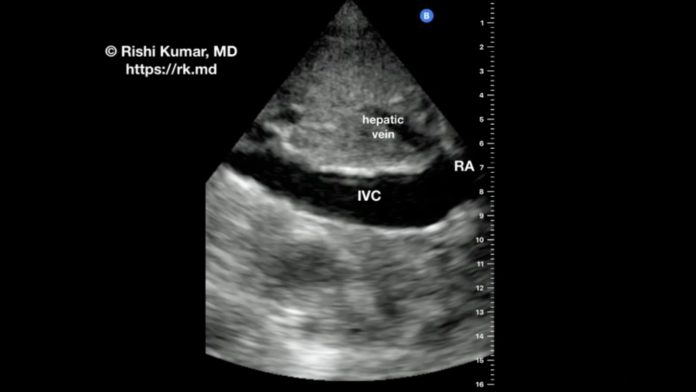 pocus-ivc-aorta