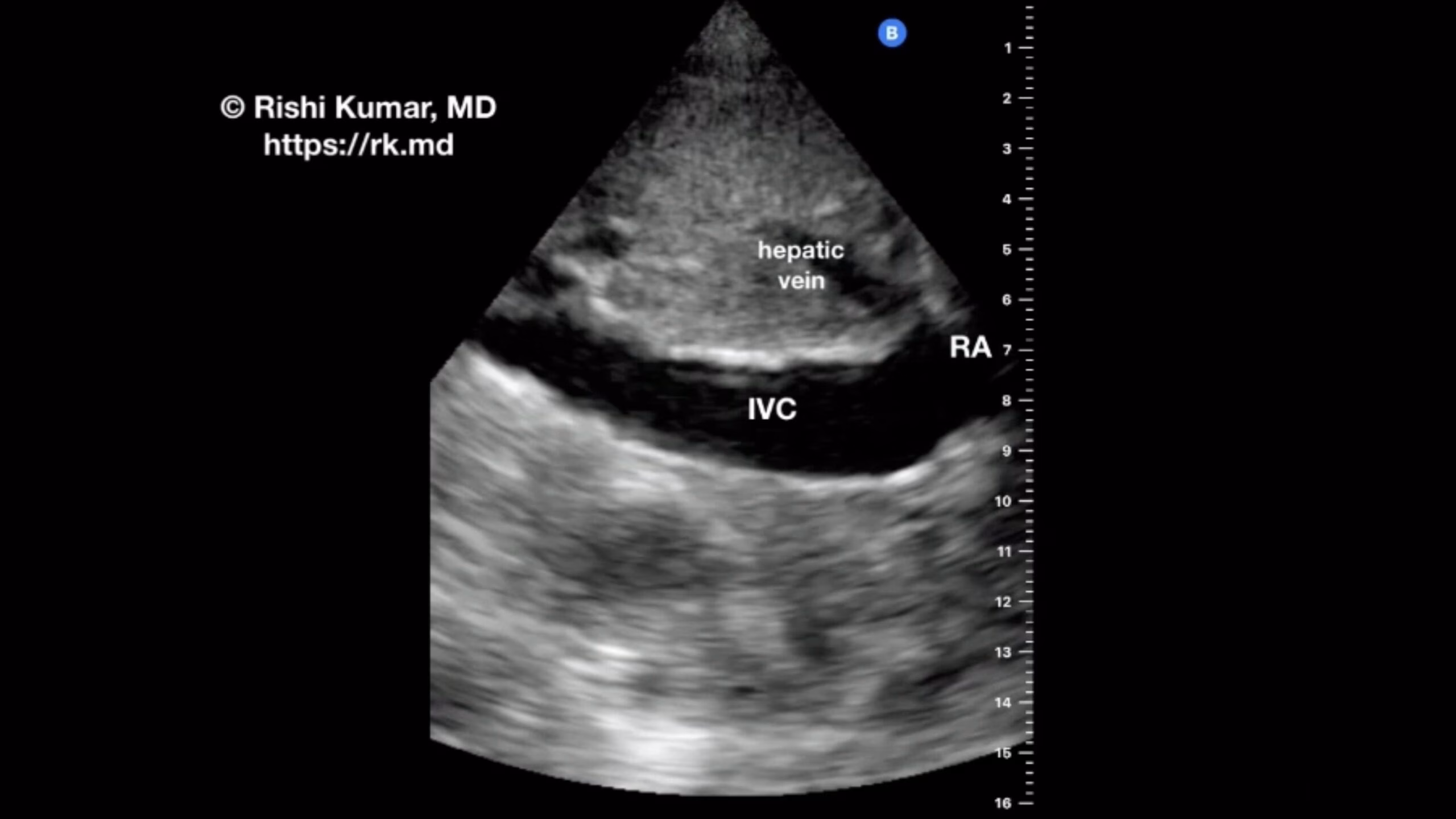 POCUS – IVC Versus Aorta
