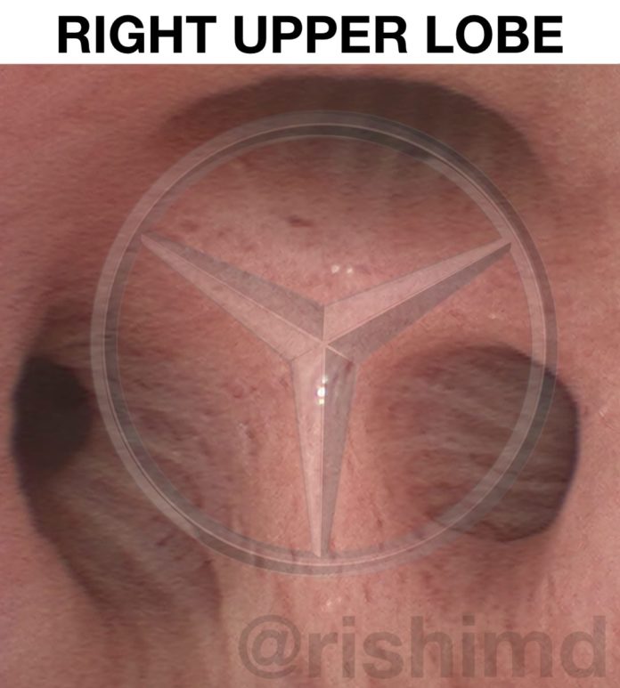 rul-bronchoscopy-mercedes