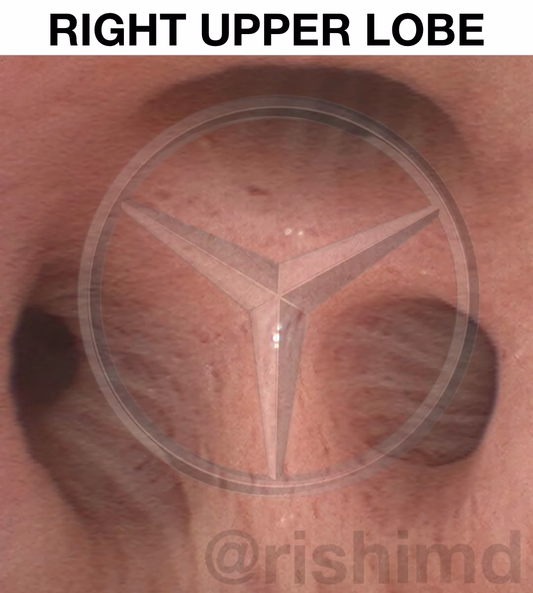 Right Upper Lobe Bronchoscopy