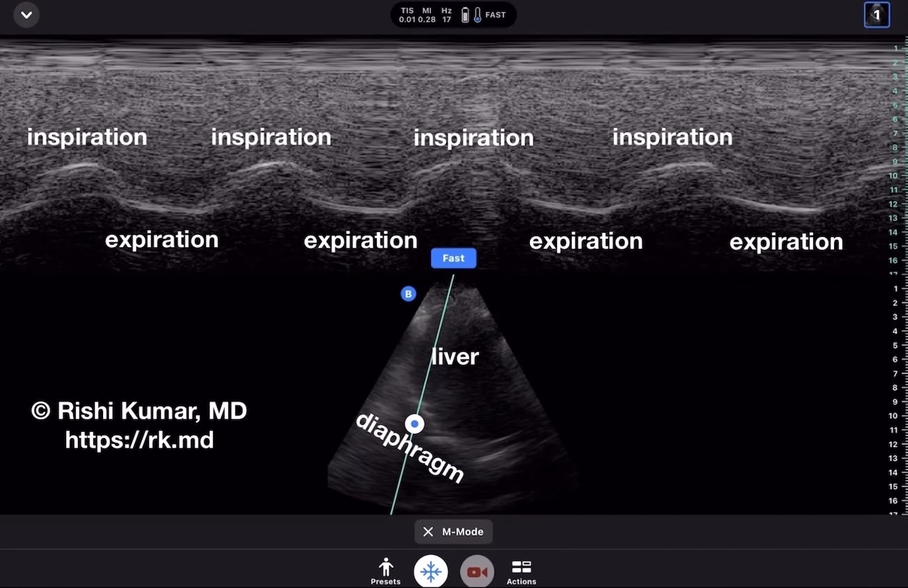 M-Mode Ultrasound Assessment Of Diaphragm Movement