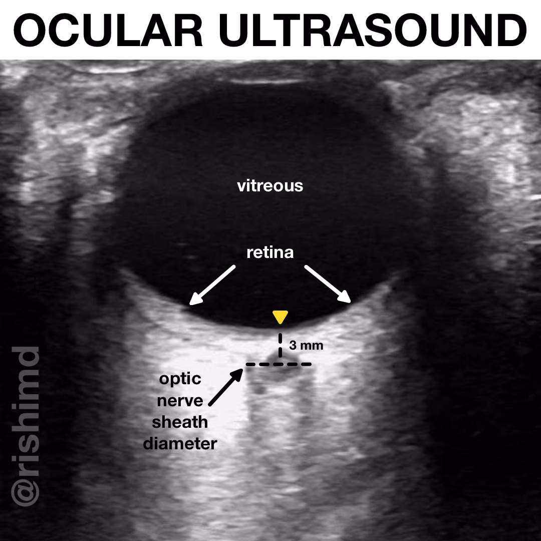 Ocular Ultrasound For Increased Intracranial Pressure