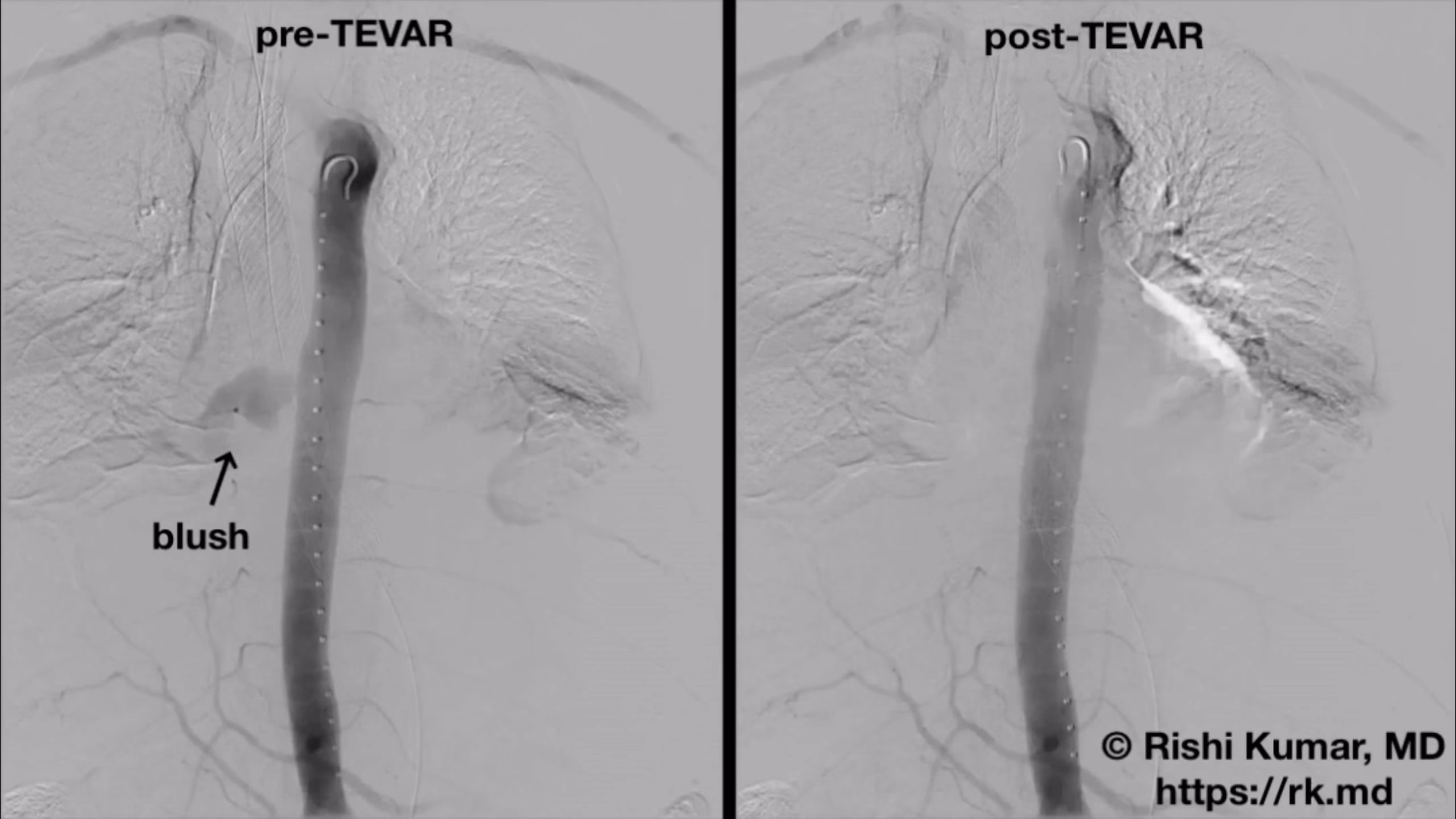 TEVAR For Aorto-Esophageal Fistula