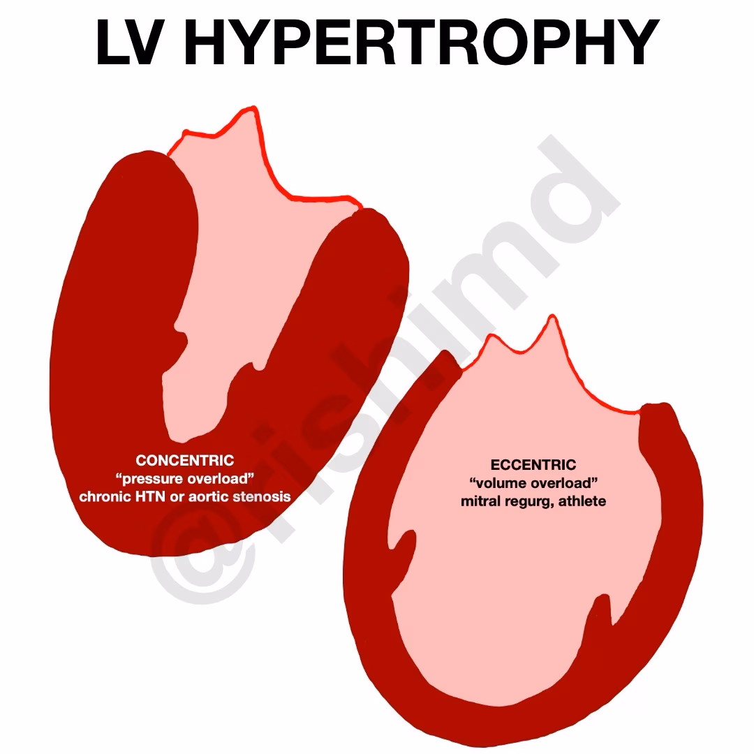 Eccentric Versus Concentric Hypertrophy