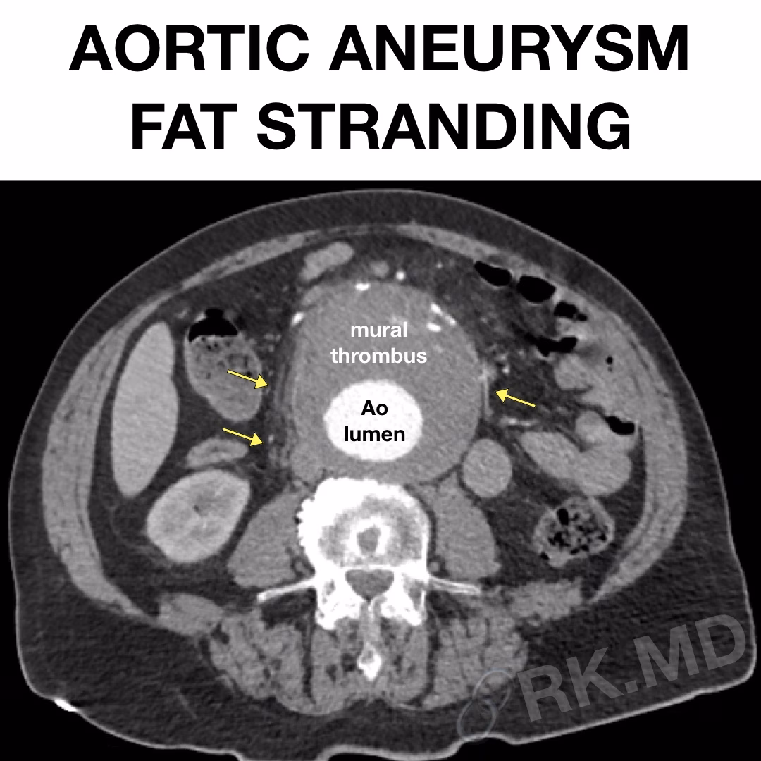 Aortic Aneurysm Fat Stranding On CT
