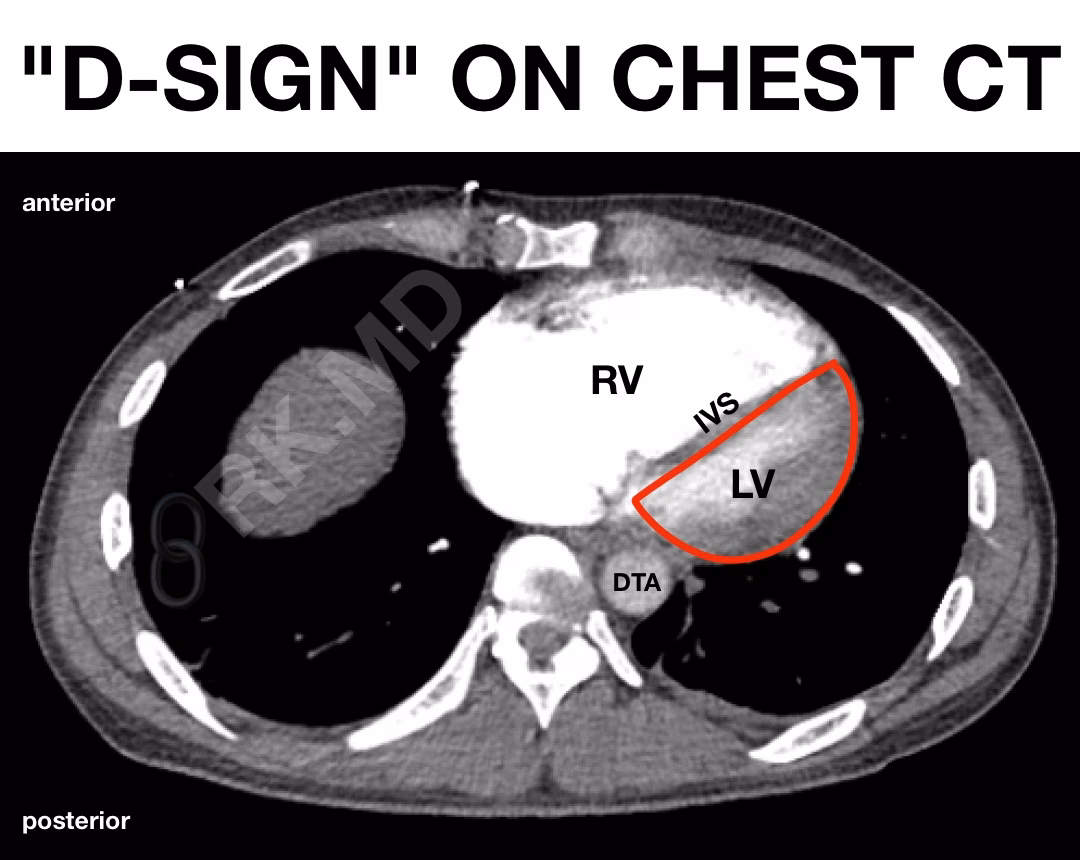 D-Sign: Right Ventricular Strain On Chest CT And Echocardiography
