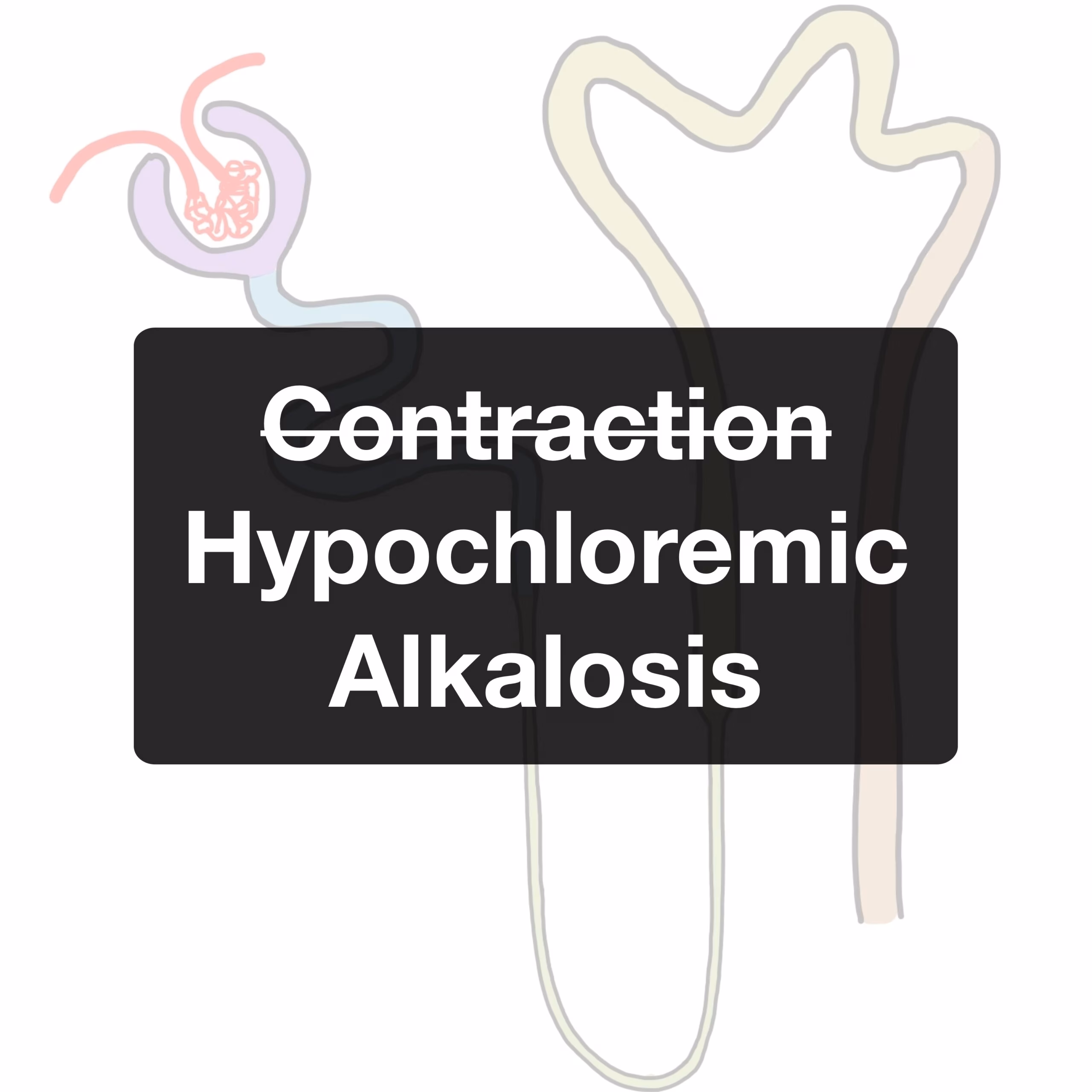 Hypochloremic (“Contraction”) Alkalosis