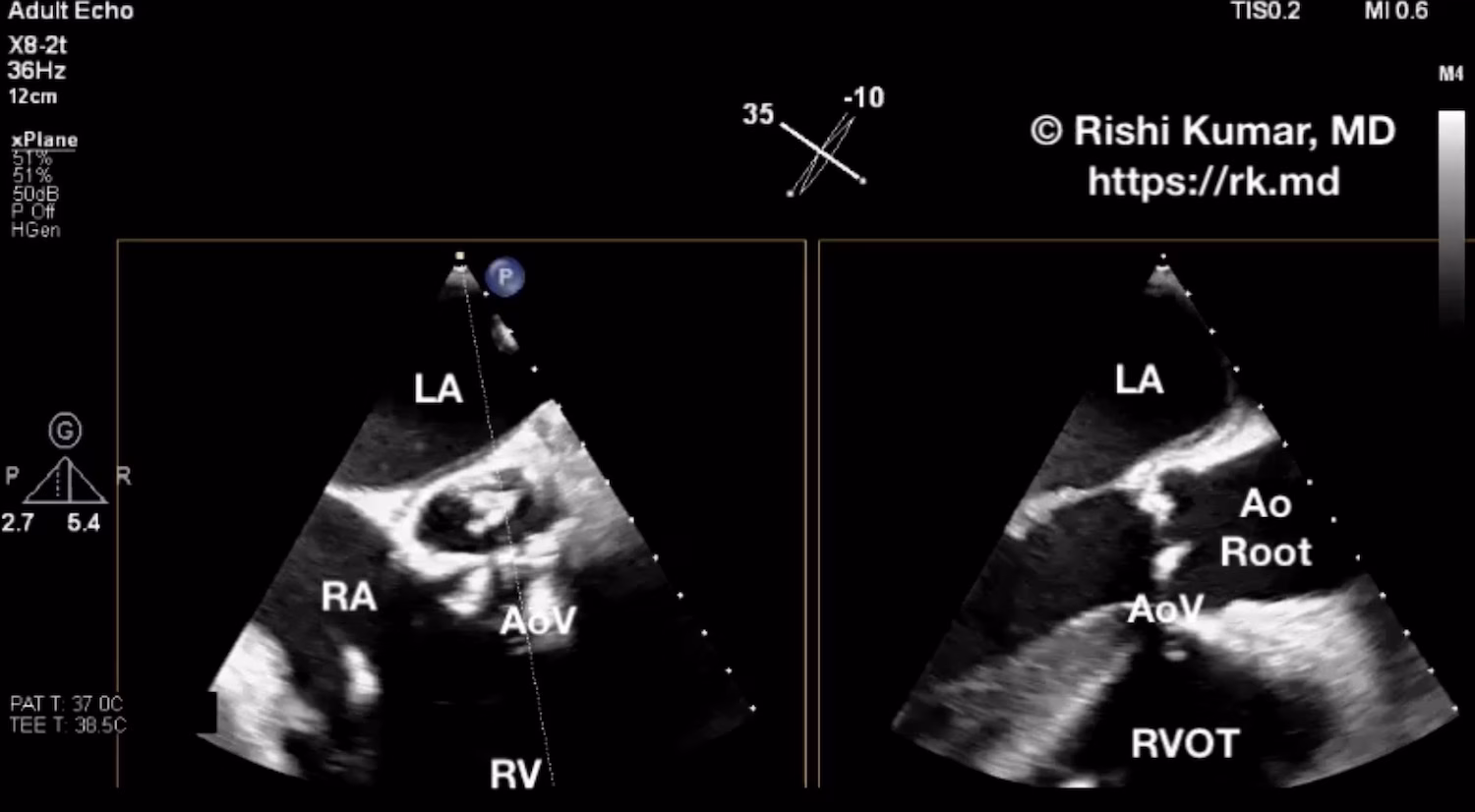 Libman-Sacks Endocarditis