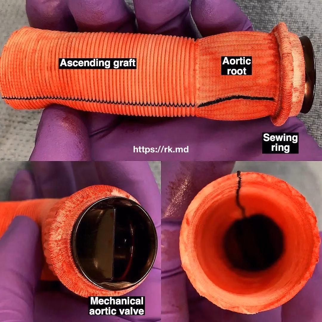 Bentall Procedure