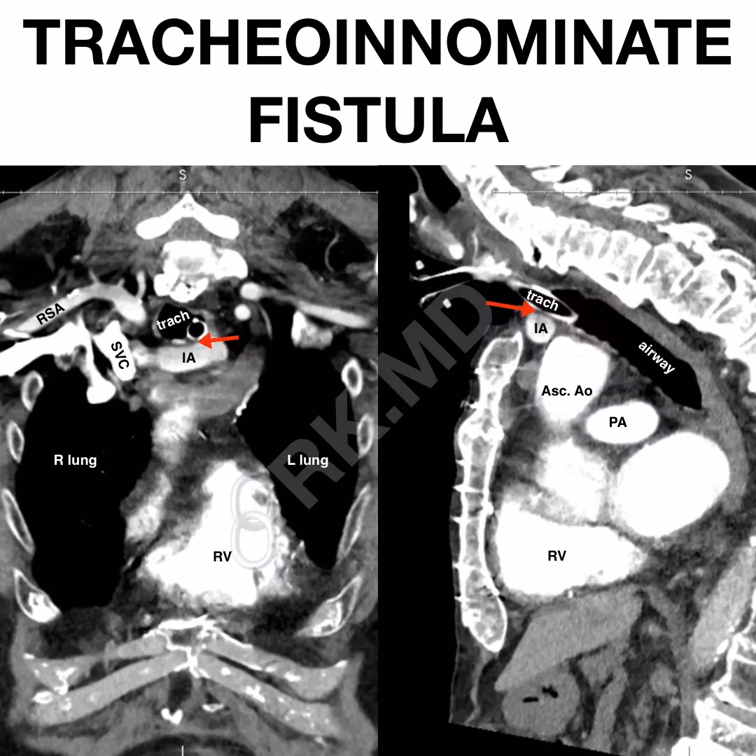 Tracheoinnominate Fistula