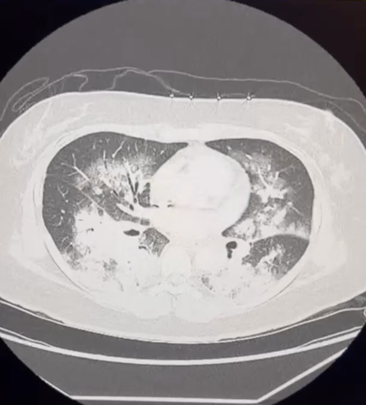 High Altitude Pulmonary Edema (HAPE)