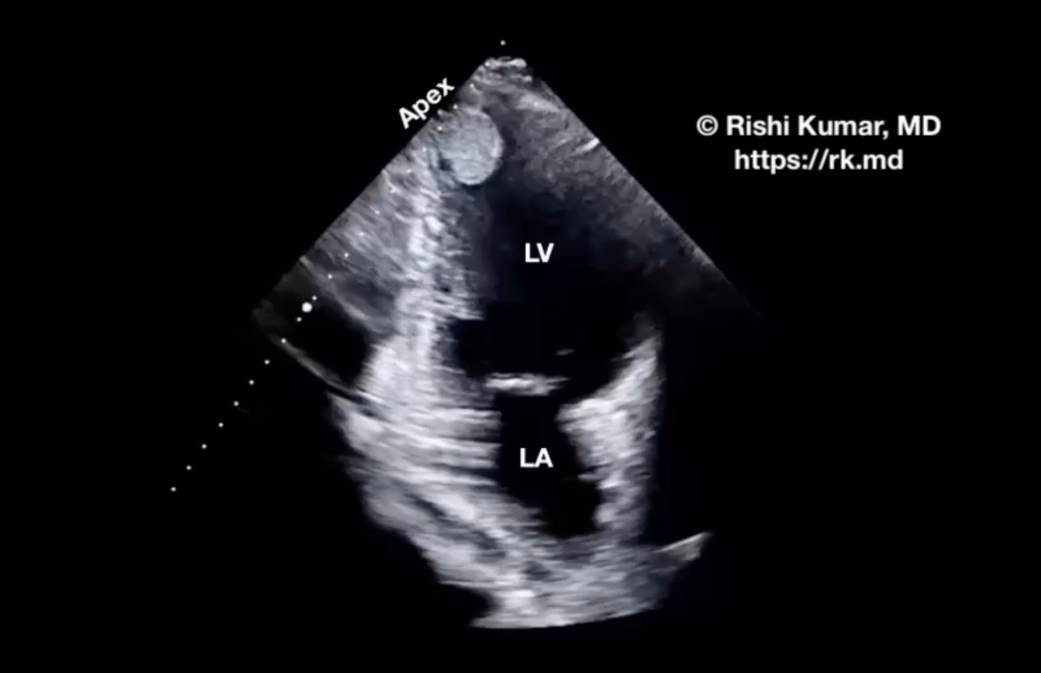 Left Ventricular (LV) Thrombus