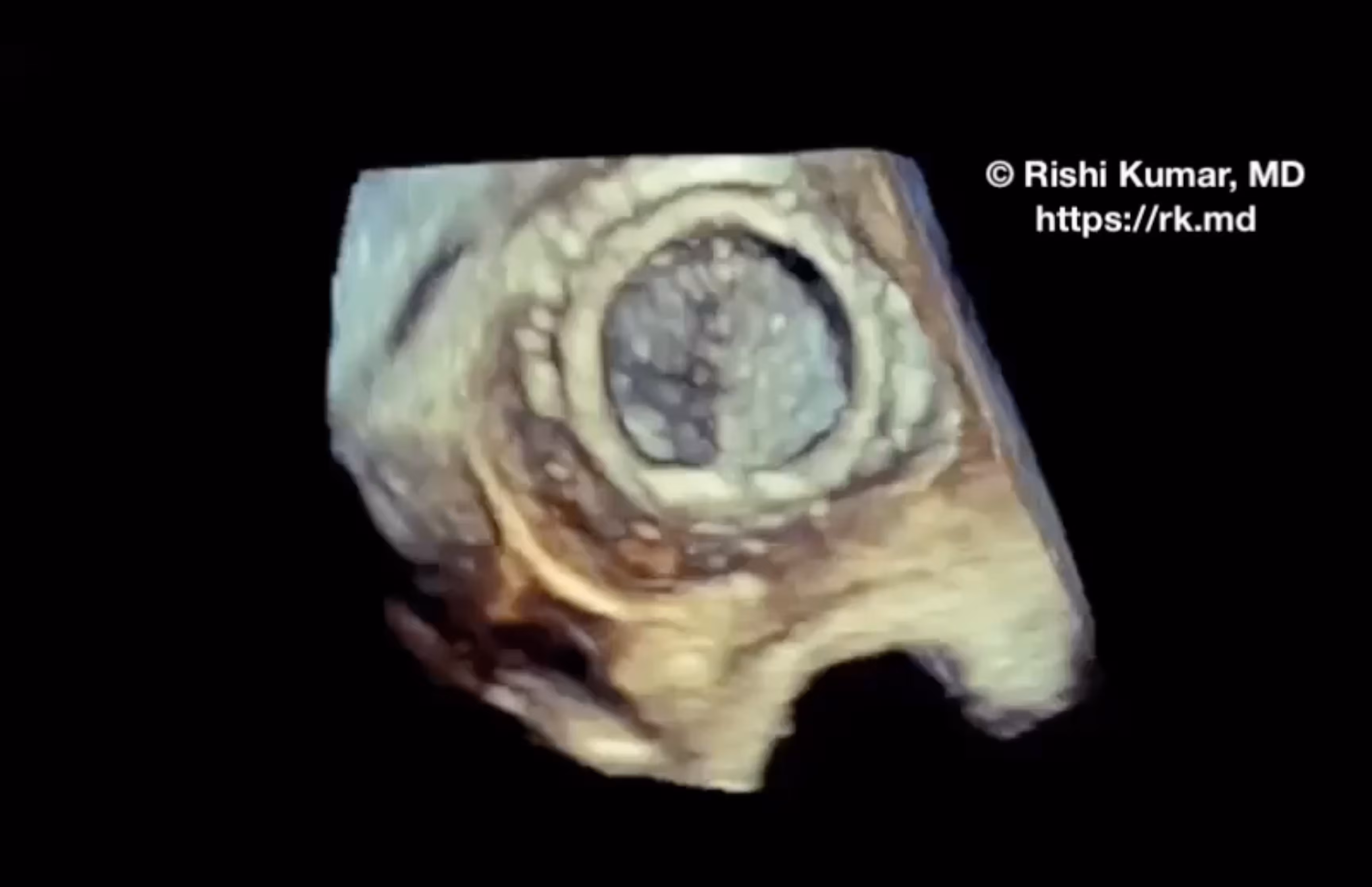 On-X Mitral Valve Stuck Leaflet