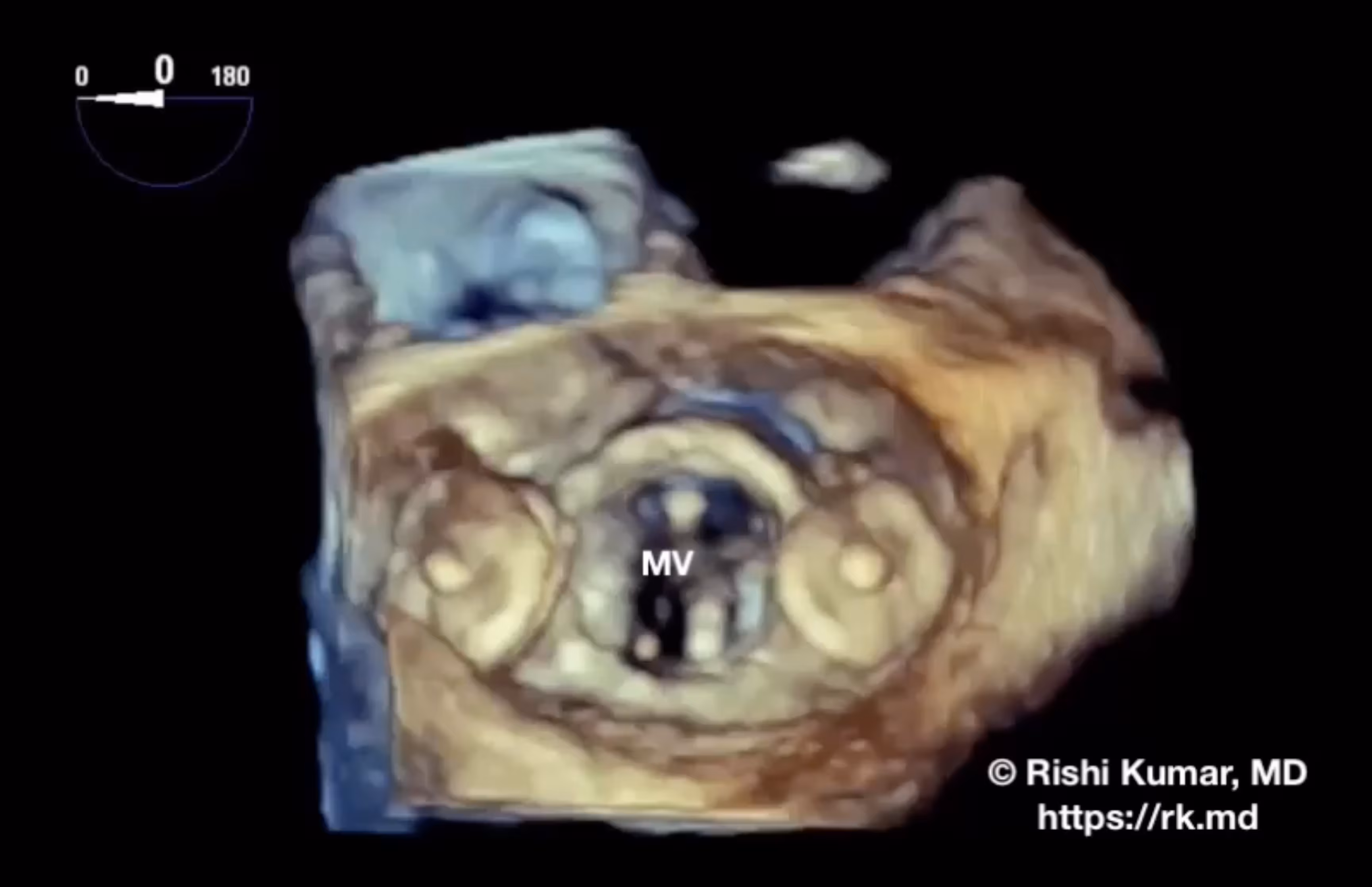 Mitral Valve Paravalvular Leak Closure
