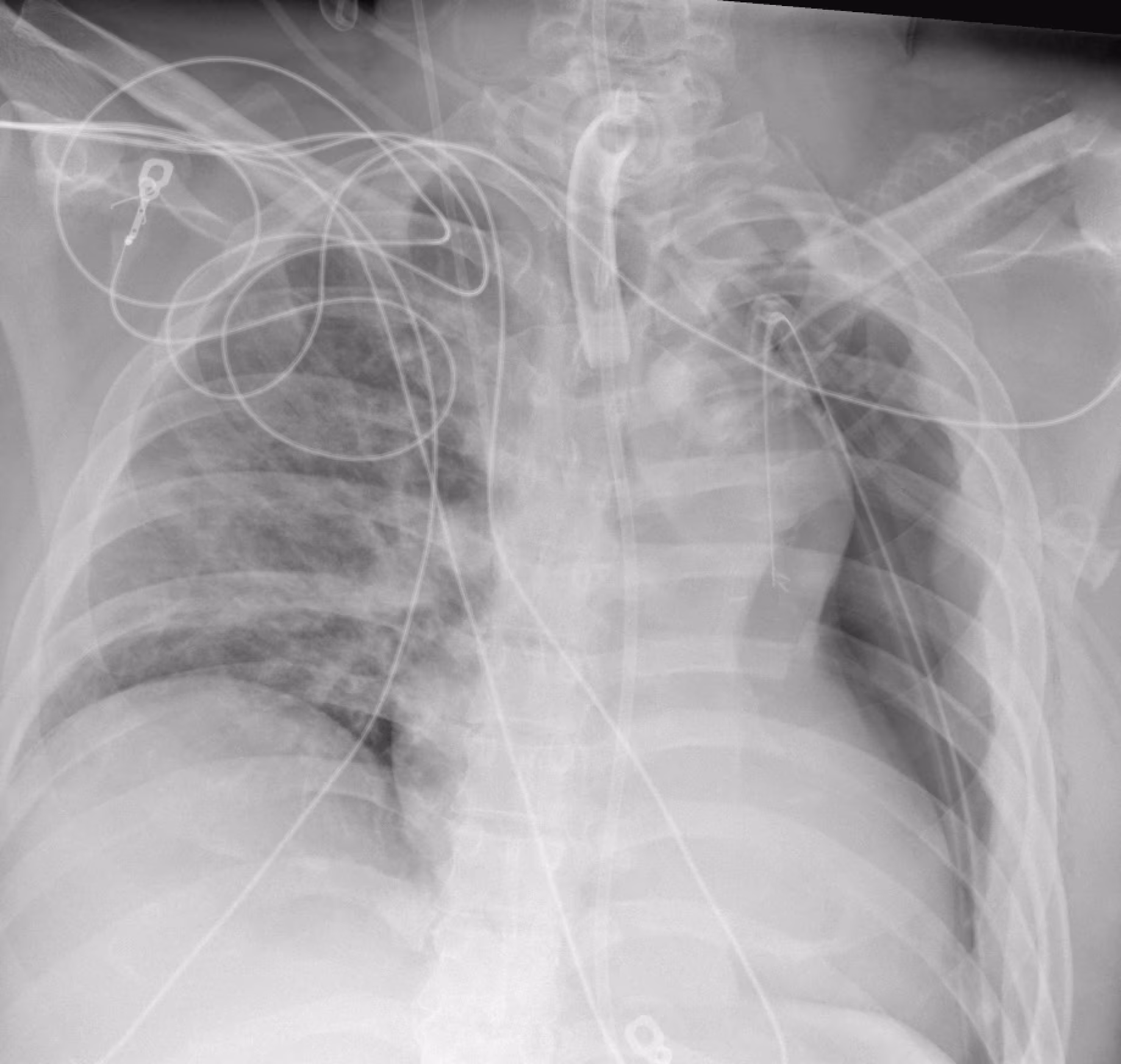 Total Pneumonectomy